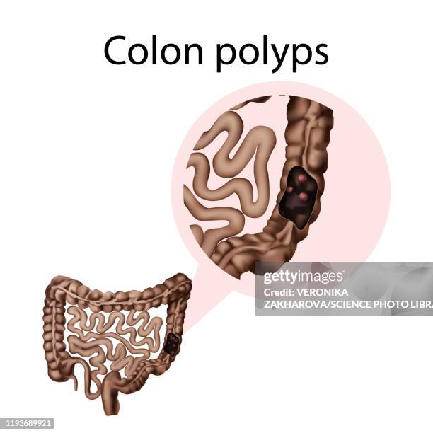 colon polyps, illustration - colon polyp stock illustrations