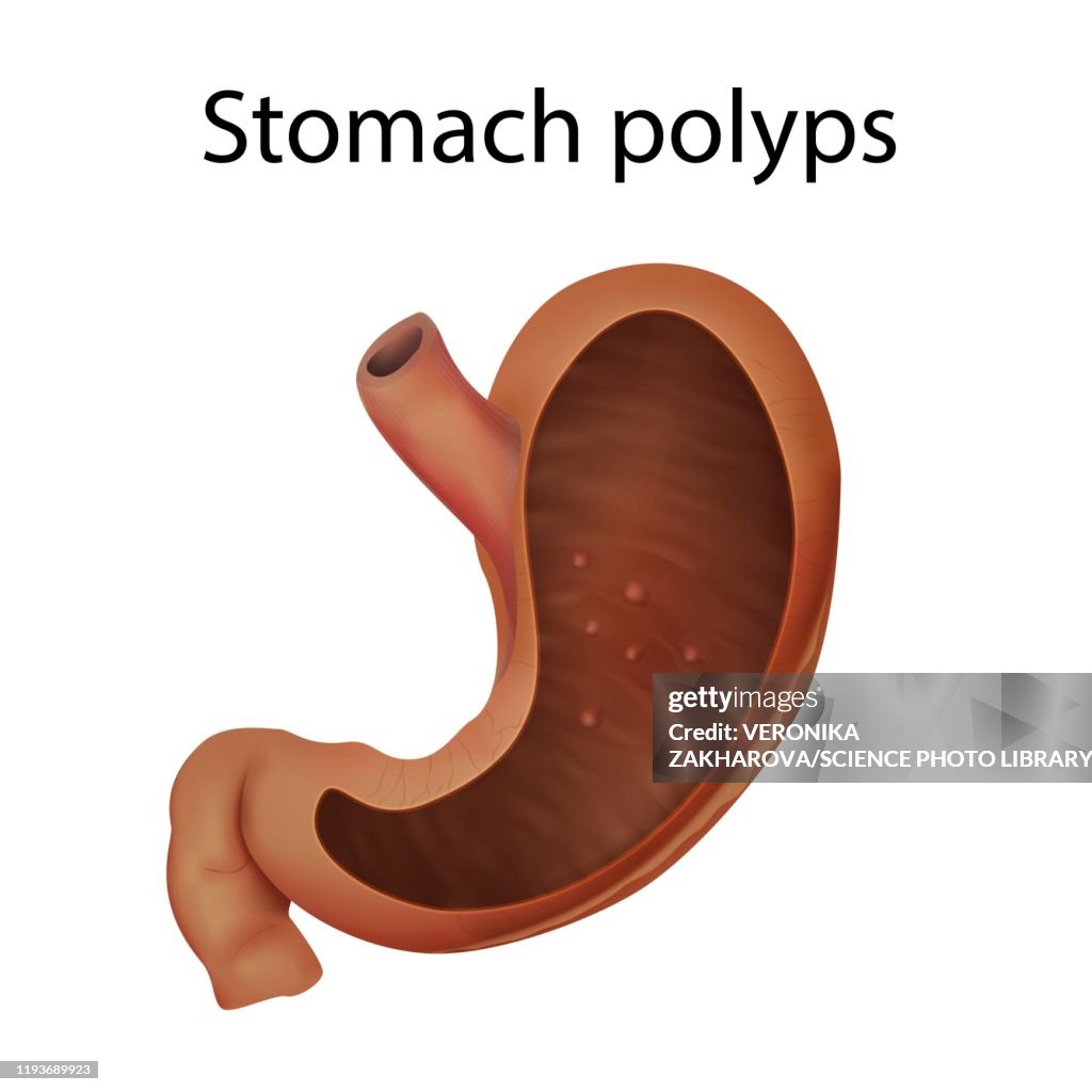 Stomach polyps, illustration