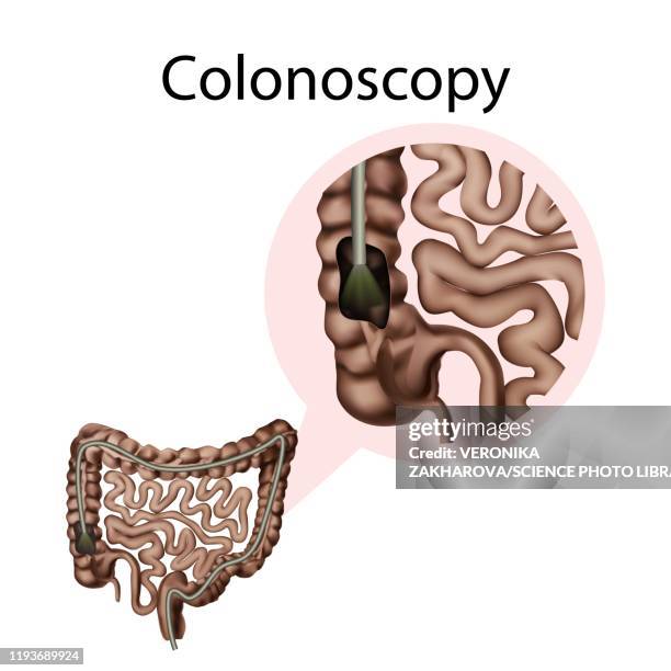 Colonscopy Test Image 125 Colonoscopy Test High Res Illustrations - Getty Images