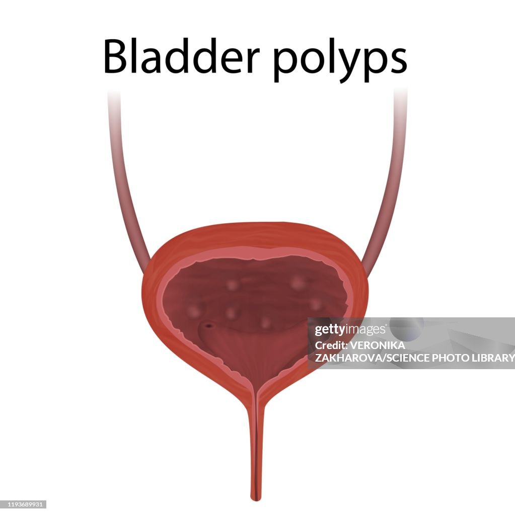 Bladder polyps, illustration