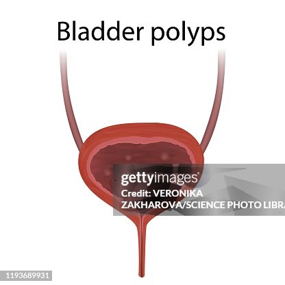 Bladder Polyps Illustration High-Res Vector Graphic - Getty Images