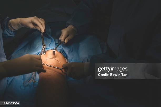 un grupo de cirujanos y enfermeras que operan en la pierna de un paciente chino en el quirófano - varices fotografías e imágenes de stock