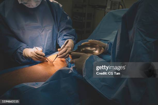 eine gruppe von chirurgen und krankenschwestern, die am bein eines chinesischen männlichen patienten im operationssaal operieren - krampfader stock-fotos und bilder
