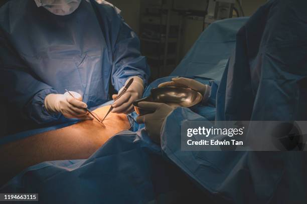 a group of surgeon and nurses operating on a chinese male patient's leg in operating room - surgery stitches stock pictures, royalty-free photos & images