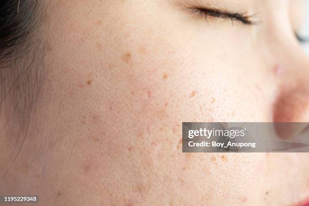 close up of woman face has scar problems with aging wrinkle on her face. - pores stockfoto's en -beelden