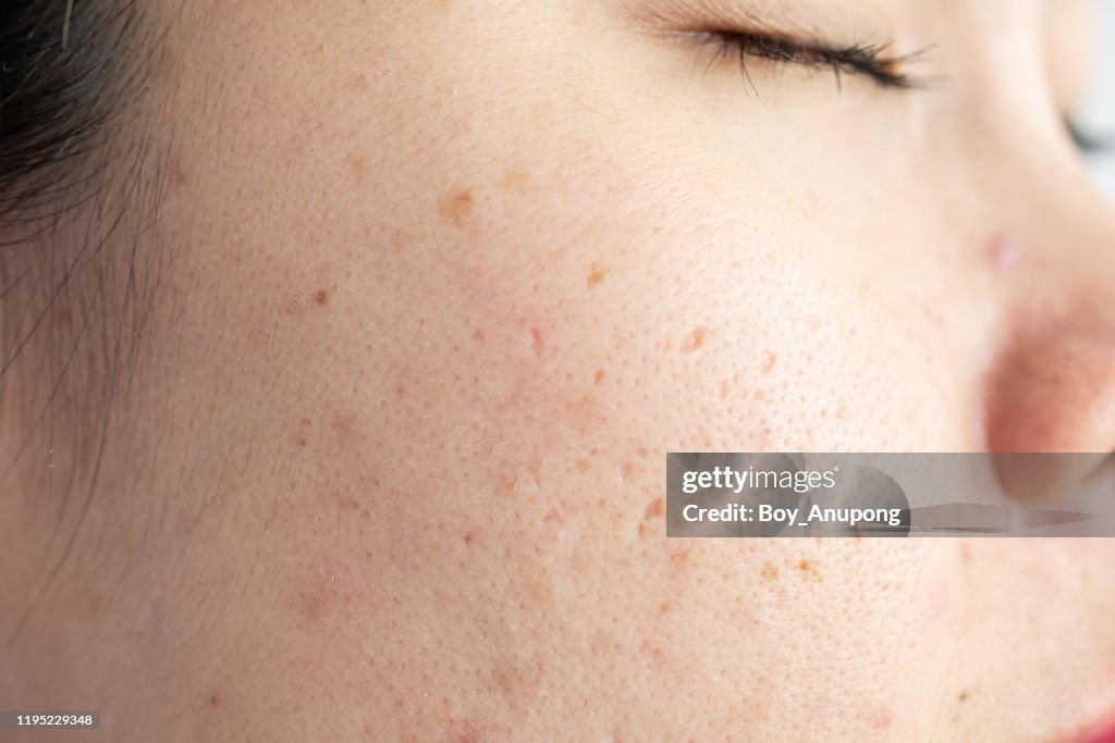 Face Problem Wrinkle Close Up Of Woman Face Has Scar Problems With Aging Wrinkle On Her Face ...