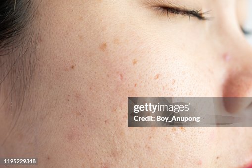 Close up of woman face has scar problems with aging wrinkle on her face. Close up of woman face has scar problems with aging wrinkle on her face.