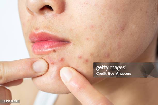 Exploding Infected Pimples 634 Infected Pimples Stock Photos, High-Res Pictures, and Images ...