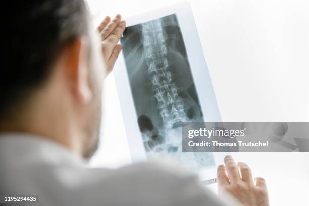 The X-ray image of a spinal column with diagnosed scoliosis is held in front of an illuminated area on January 22, 2020 in Berlin, Germany.