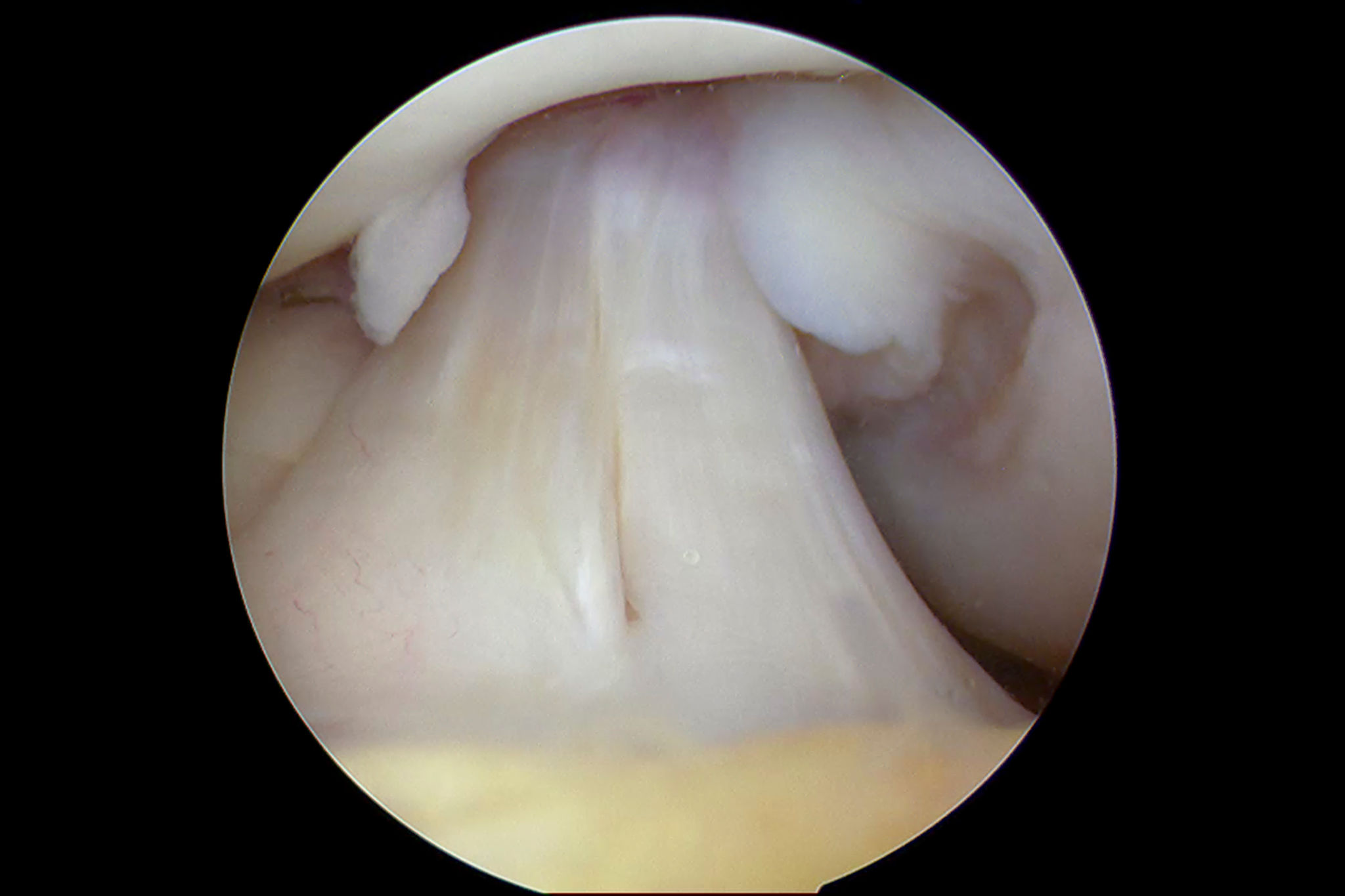bone graft recovery