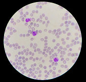 Close up Neutropil with toxic granulation on red blood cells background.