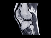 MRI Knee joint or Magnetic resonance imaging  sagittal view for detect tear or sprain of the anterior cruciate  ligament (ACL).