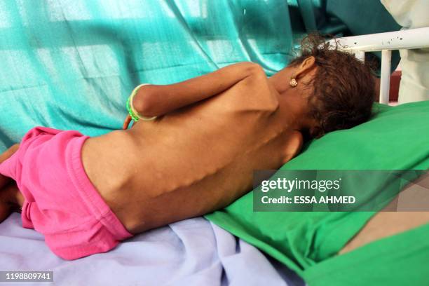 Yemeni girl suffering from malnutrition lies on a bed at a clinic in Yemen's northern Hajjah province on February 5, 2020.