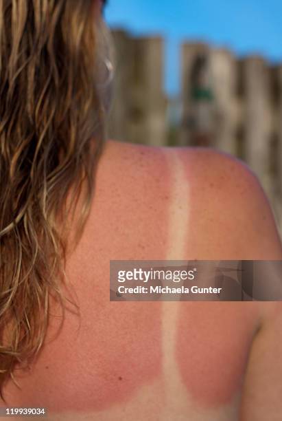 sun burn - sunburned stockfoto's en -beelden