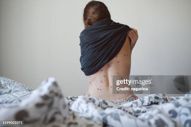 a young woman pulls her t-shirt showing half of her spine covered with chickenpox rash - varicella foto e immagini stock