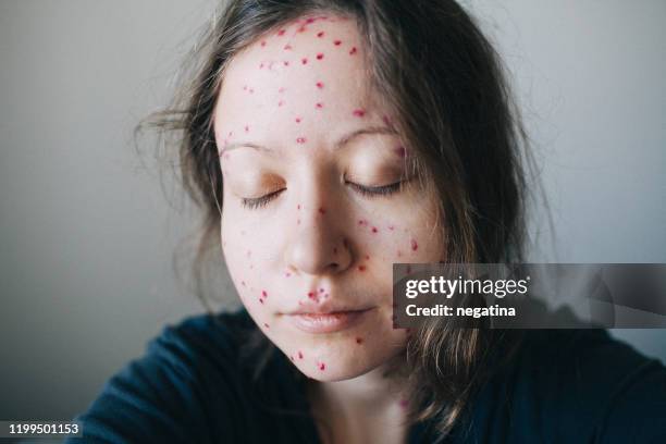 portrait of the young woman with the face covered with chickenpox eyes closed - virus de la viruela fotografías e imágenes de stock