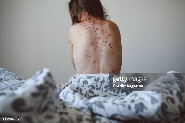 young woman sitting on the bed hugging herself with her back covered with chickenpox rash - pocken stock-fotos und bilder