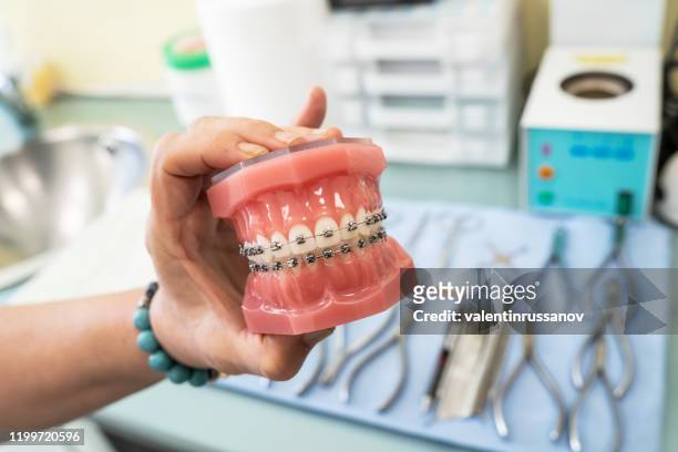 e-rthodontic modell und zahnarzt-tool - demonstration zähne modell der sorten der kieferorthopädischen halterung oder klammer - orthodontist stock-fotos und bilder
