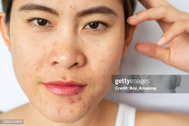 close up of woman face with the problem of acne and scar from acne inflammation (papule and pustule) on her face and she looking to camera. - ugly asian woman stock pictures, royalty-free photos & images