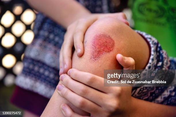 close-up of a large erosive wound on a girl's knee - wounded photos et images de collection