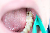 carious lesions on chewing teeth, dental caries, aesthetic defect