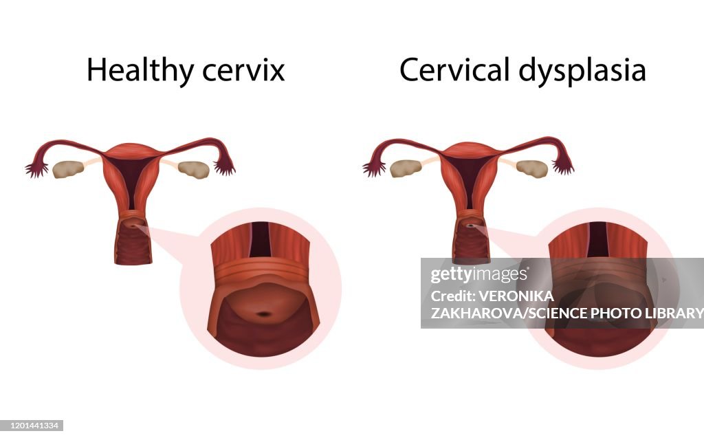 Cervical dysplasia and healthy cervix, illustration