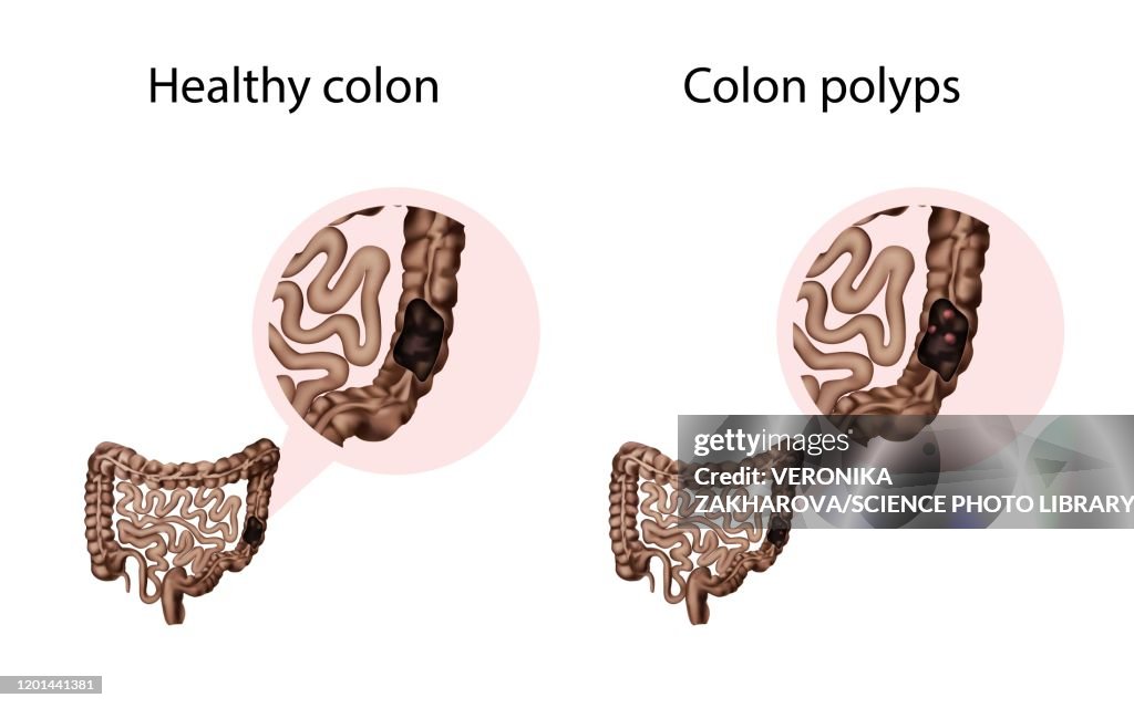 Polyp Examples Colon Polyps And Healthy Colon Illustration High-Res Vector Graphic ...