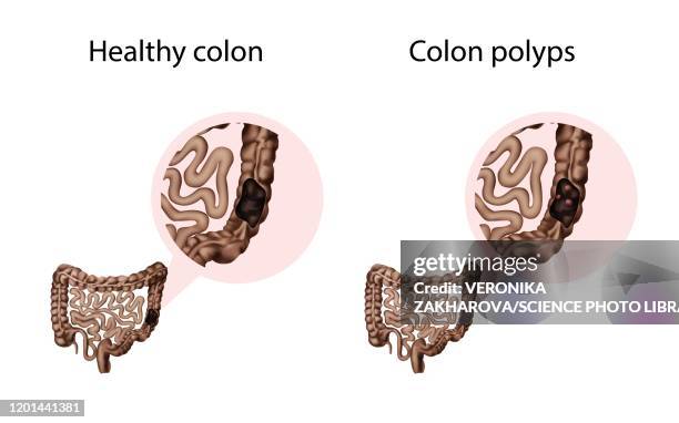 colon polyps and healthy colon, illustration - colon polyp stock illustrations