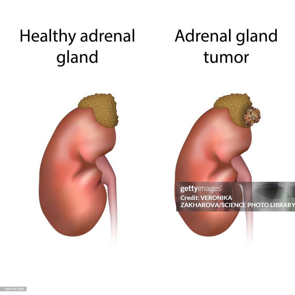 Adrenal gland tumour and healthy adrenal gland, illustration