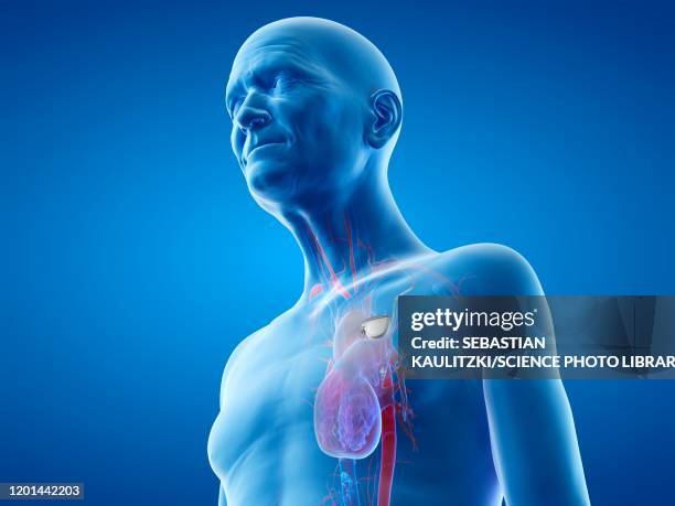 Pacemaker Person Pacemaker Technology Photos and Premium High Res Pictures - Getty Images