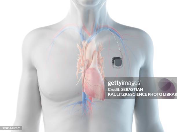 illustration of an old man with a pace maker - pacemaker stock illustrations