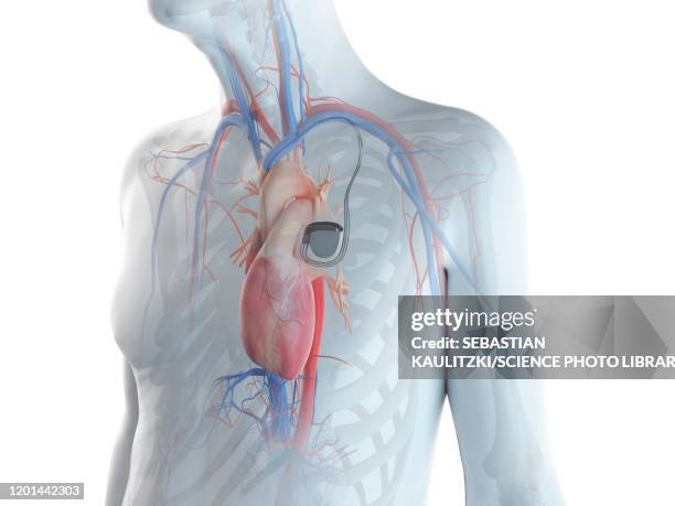 illustration of an old man with a pace maker - pacemaker stock illustrations
