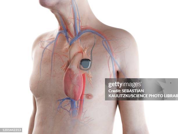 Gi Pacemaker 193 Pacemaker Technology Stock Photos, High-Res Pictures, and Images ...