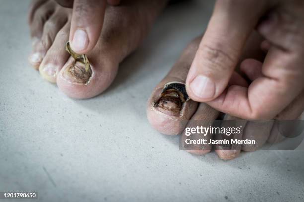 black toenail peeling off - images of ugly feet stock pictures, royalty-free photos & images