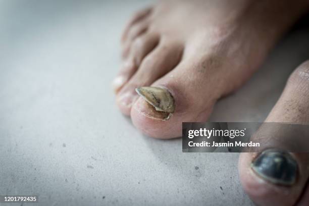 toe nail peeling off - ugly black women stock pictures, royalty-free photos & images