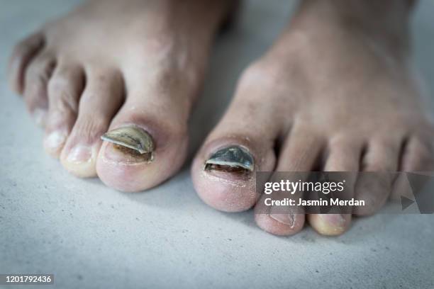 toe nail peeling off - foot fungus stock pictures, royalty-free photos & images