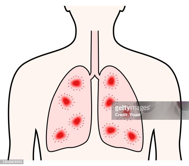mers covコロナウイルス呼吸器感染症。人間肺の概念 - aids test点のイラスト素材／クリップアート素材／マンガ素材／アイコン素材
