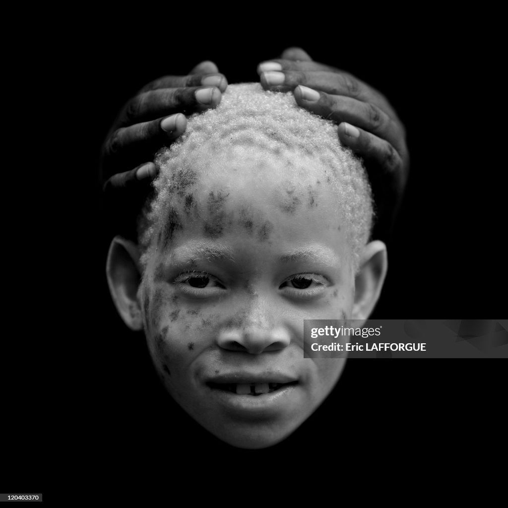 Zamda, Albino Girl In Mikindani, Tanzania On February 08, 2009 -
