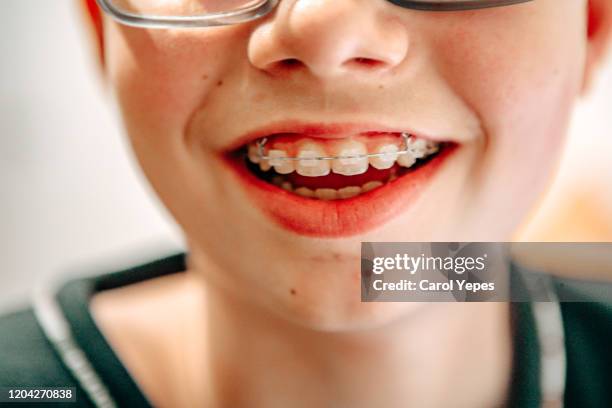 closeup boy in braces - teeth braces stock pictures, royalty-free photos & images