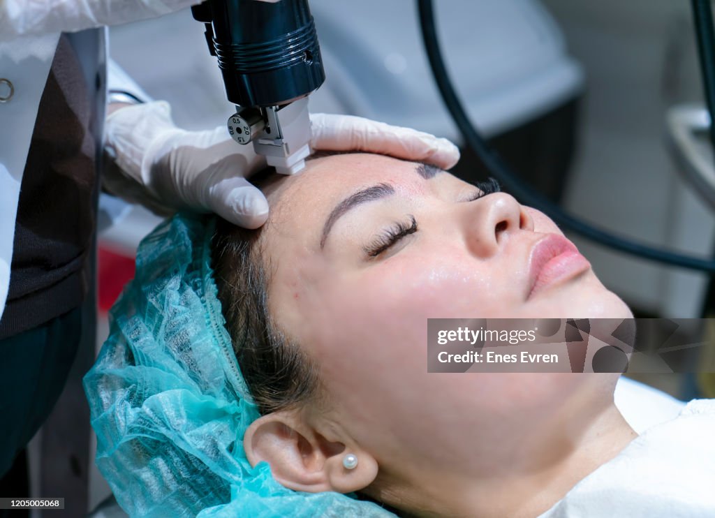 Intracel radiofrequency microneedling treatment