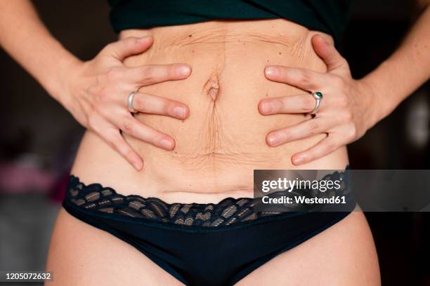 postpartum flabby and wrinkled belly skin with c-section scar - cicatriz imagens e fotografias de stock