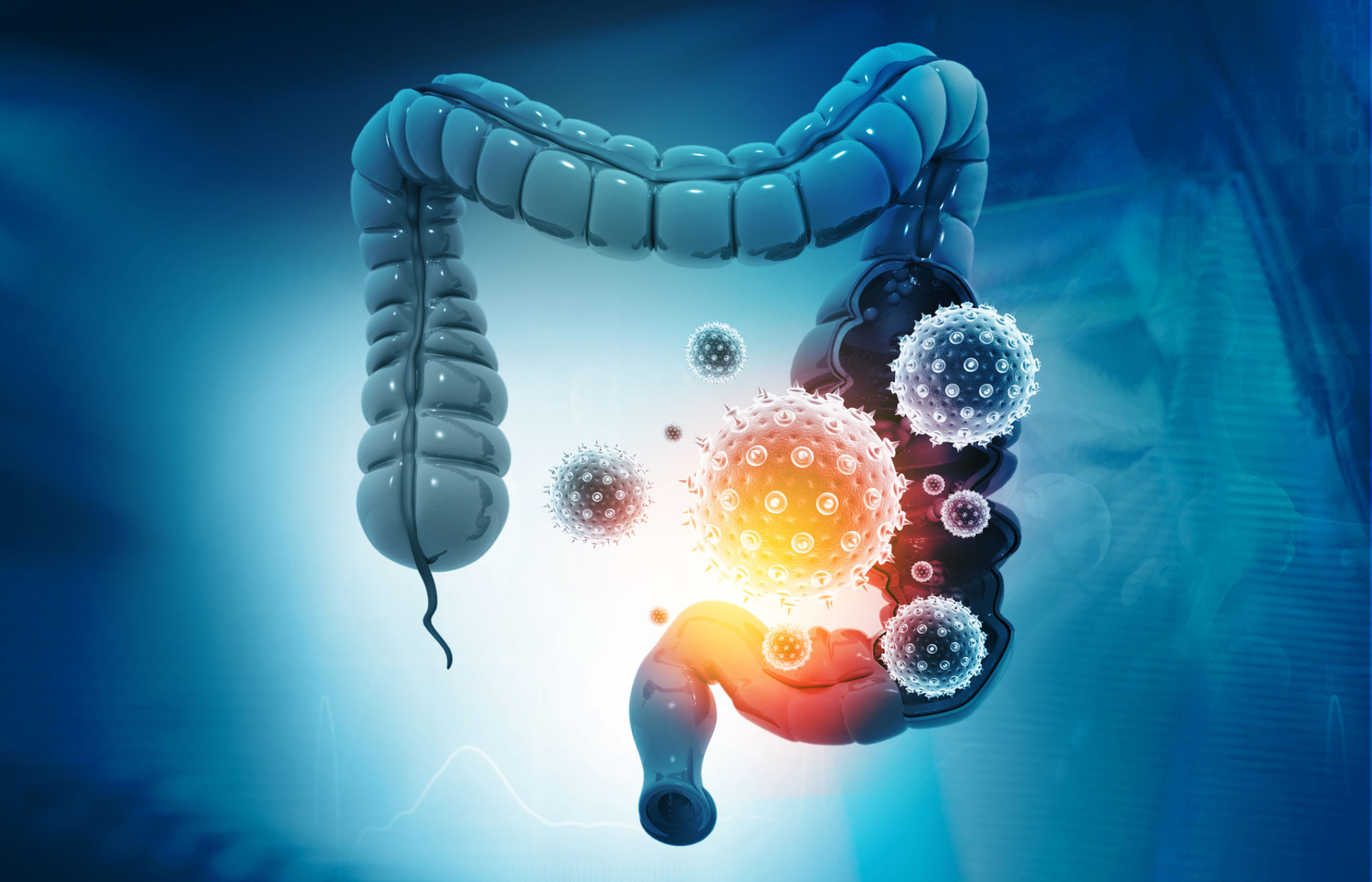 Colon cancer, bacteria, viruses in sick unhealthy intestine Colon cancer, bacteria, viruses in sick unhealthy intestine
