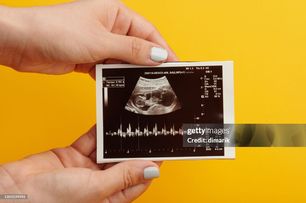 健康嬰兒的超聲波掃描