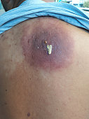 Surgical wound  large abscess with surrounding cellulitis. Huge upper back abscess require drainage in diabetic patient.