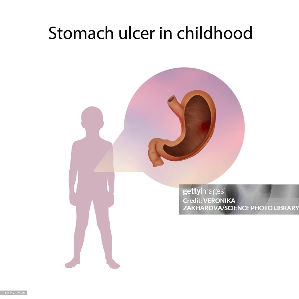 Ulcerease Children Stomach Ulcer In Childhood Illustration High-Res Vector Graphic - Getty ...