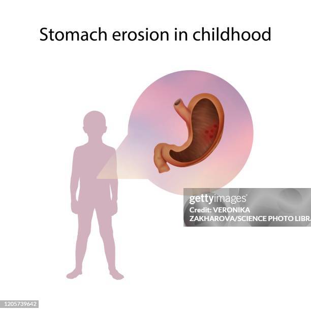 stomach erosion in childhood, illustration - heartburn stock illustrations