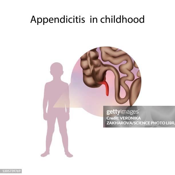 appendicitis in childhood, illustration - appendicitis stock-grafiken, -clipart, -cartoons und -symbole