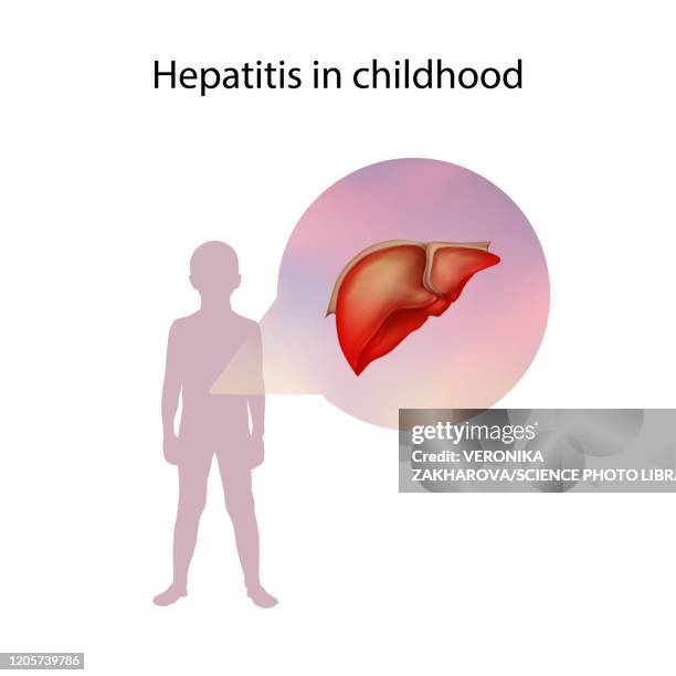 hepatitis in childhood, illustration - hepatitis fotografías e imágenes de stock