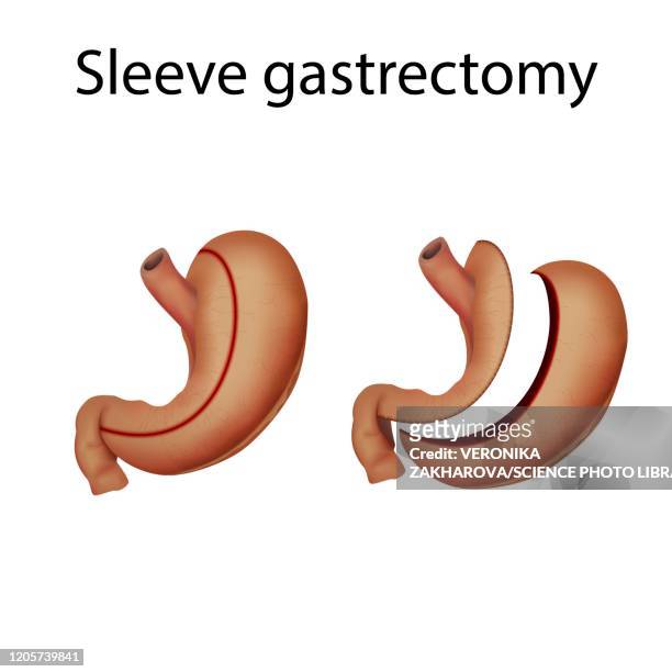 illustrations, cliparts, dessins animés et icônes de sleeve gastrectomy, illustration - digestive system