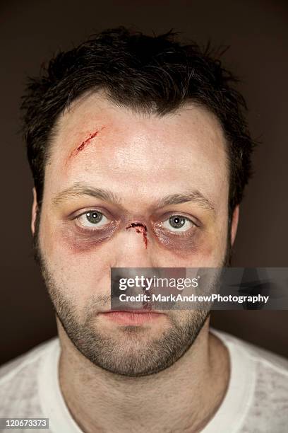 facial injuries - wounded stockfoto's en -beelden